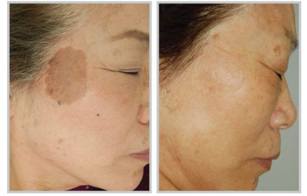 Intense Pulsed Light Skin Secrets