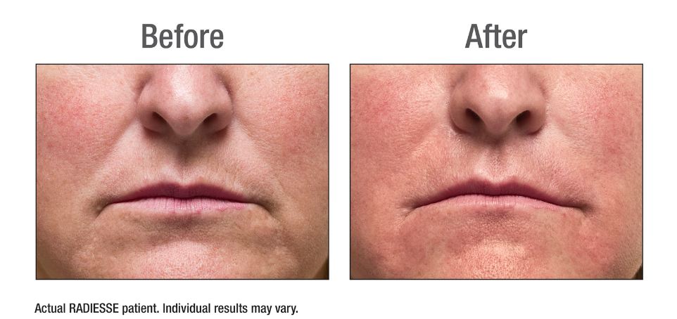 Radiesse Moderate Before & After