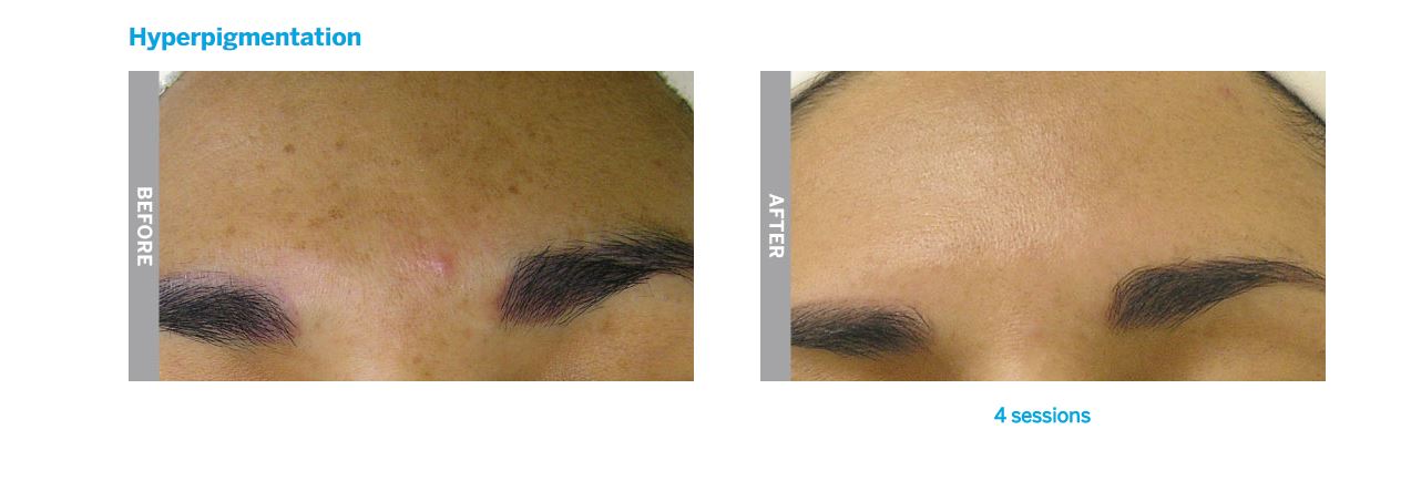 hydrafacial hyperpigmentation