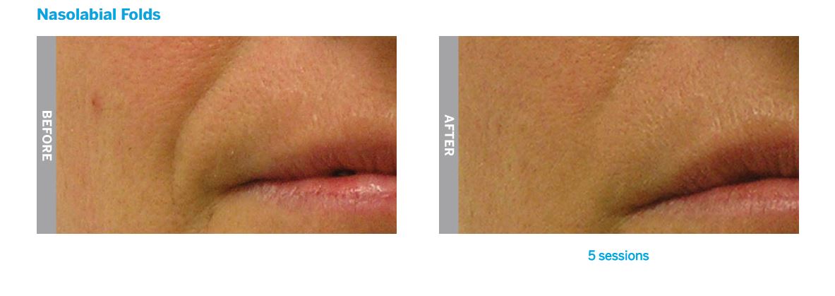 hydrafacial
